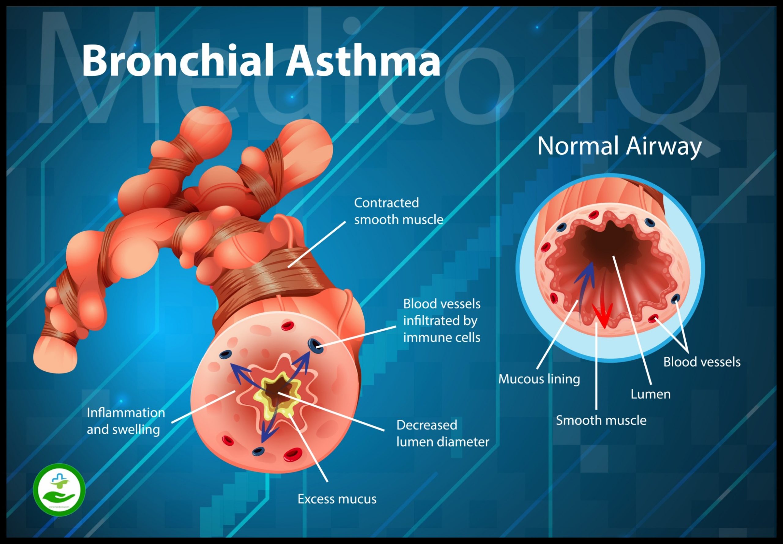 Bronchial Asthma the asthma pathophysiology