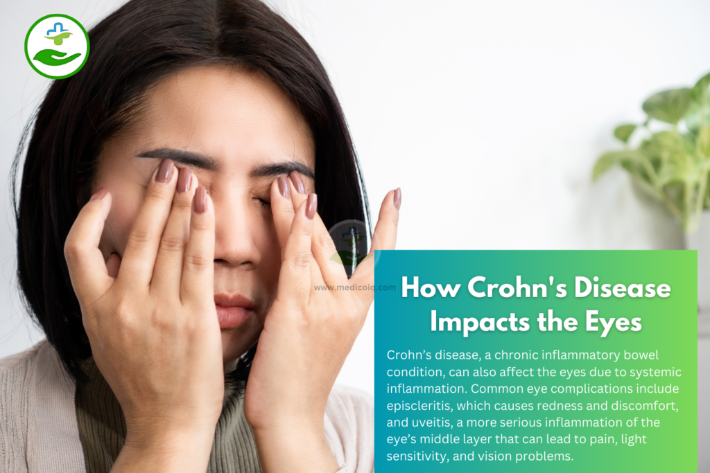 How Crohn's Disease Impacts the Eyes