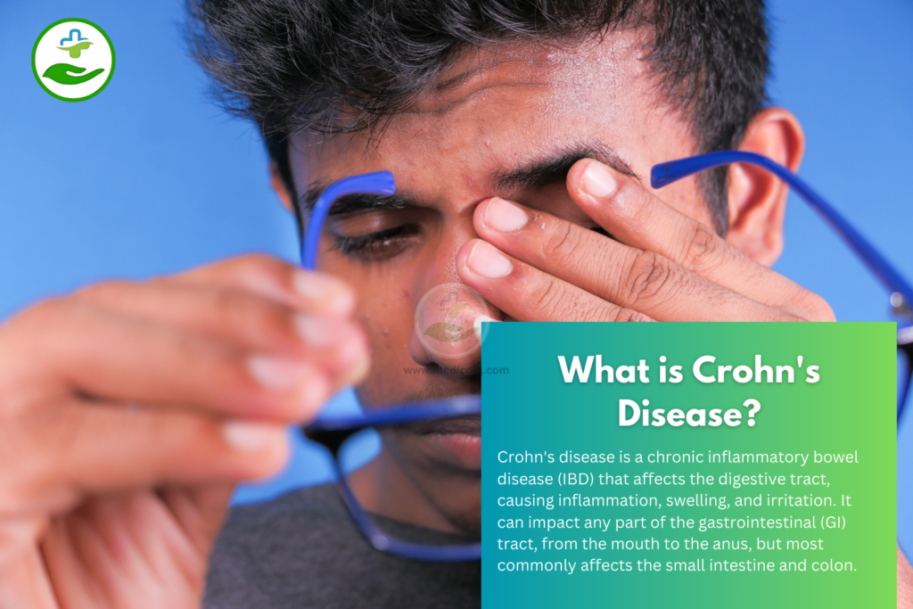 What is Crohn's Disease?