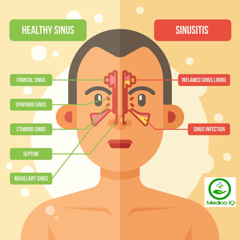 Sinusitis Causes, Symptoms & Treatment ( Sinus Infection ) Medico IQ