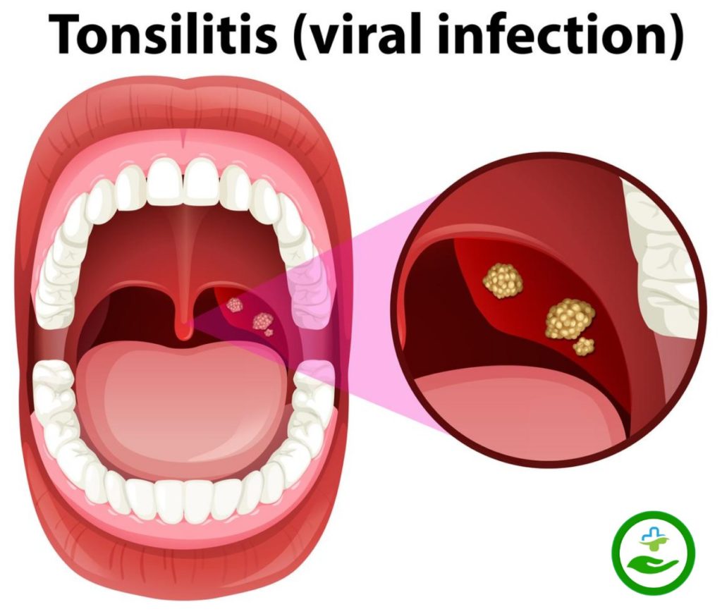 Tonsillitis-Causes,Symptoms,Treatment & Home remedies - Medico IQ