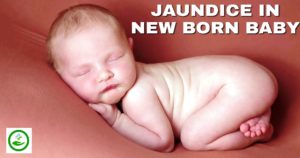 Jaundice in new born baby
