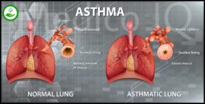 Pathophysiology of asthma