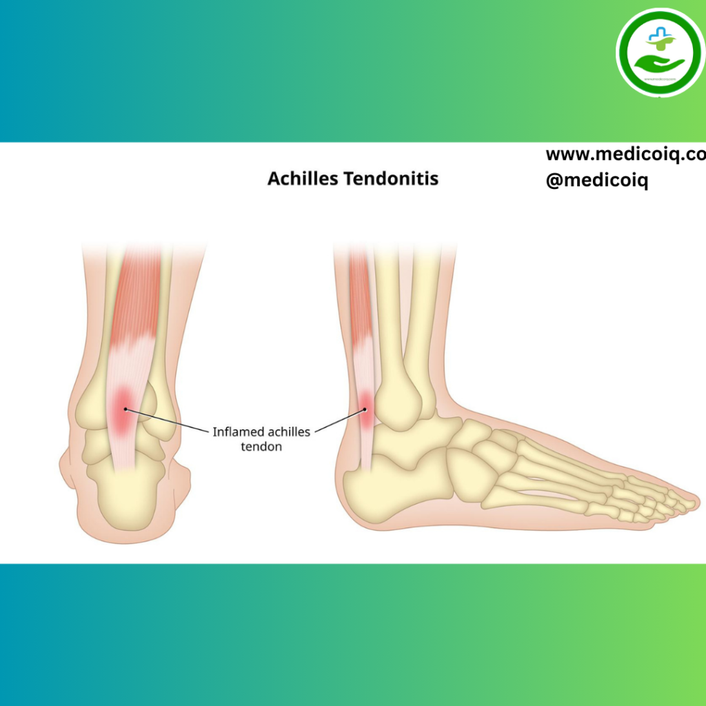 Achilles tendonitis Understanding Foot Pain: An Essential Guide to Foot Pain Chart