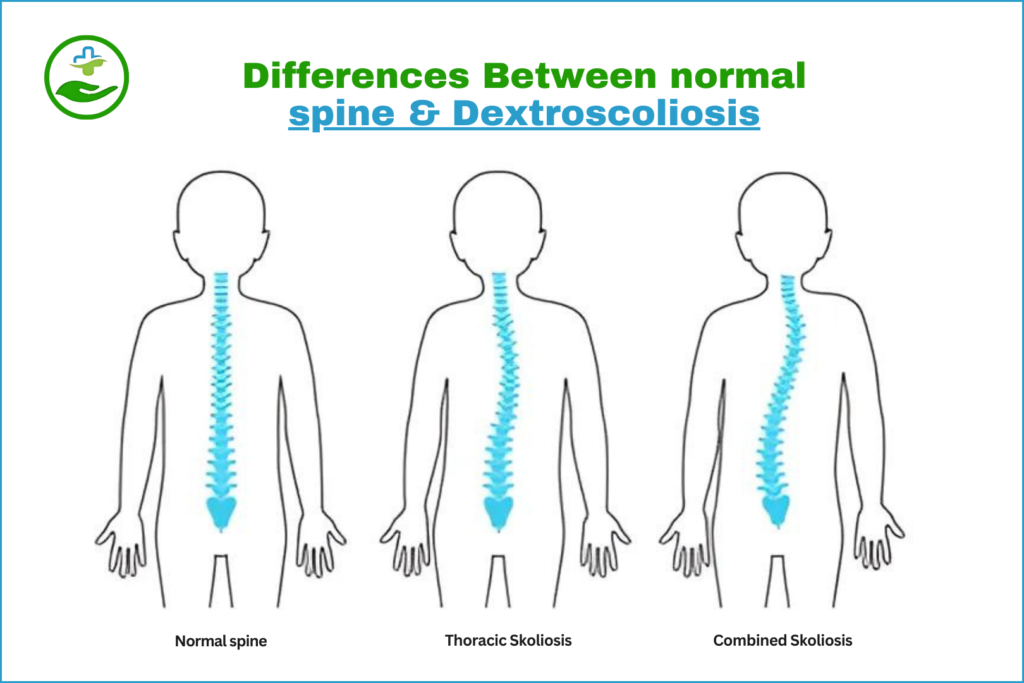 dextroscoliosis