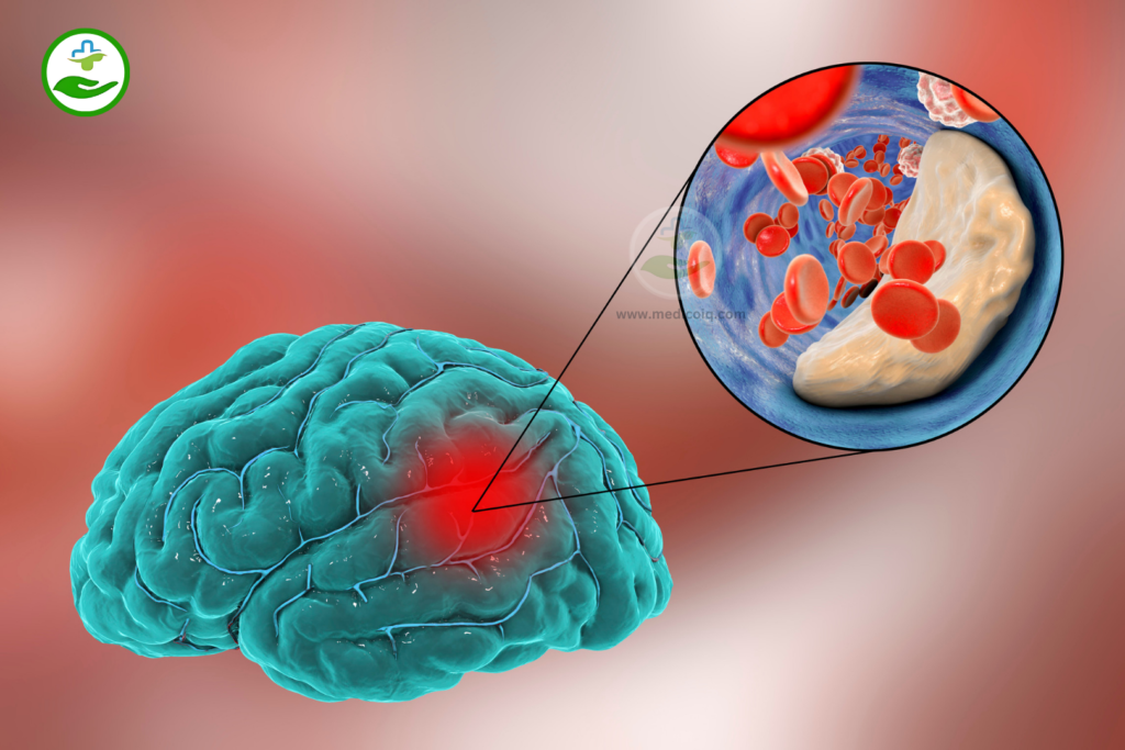 Neurological Disorders