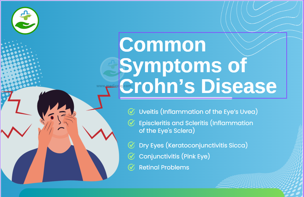 image Crohn's Disease Eyes: Symptoms, Diagnosis & Treatment Tips