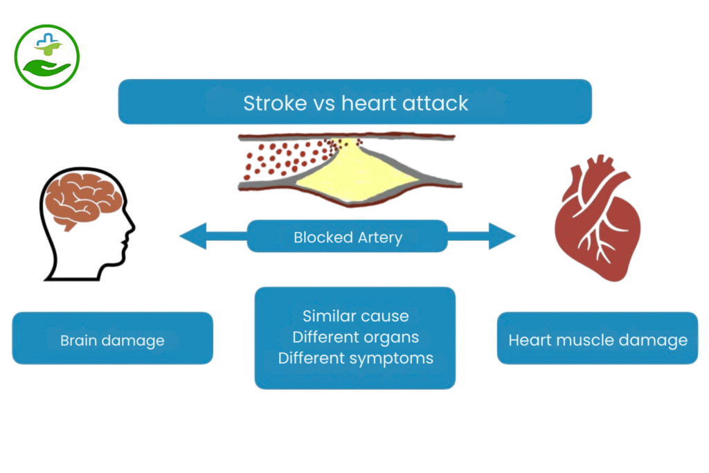 Stroke vs heart attack