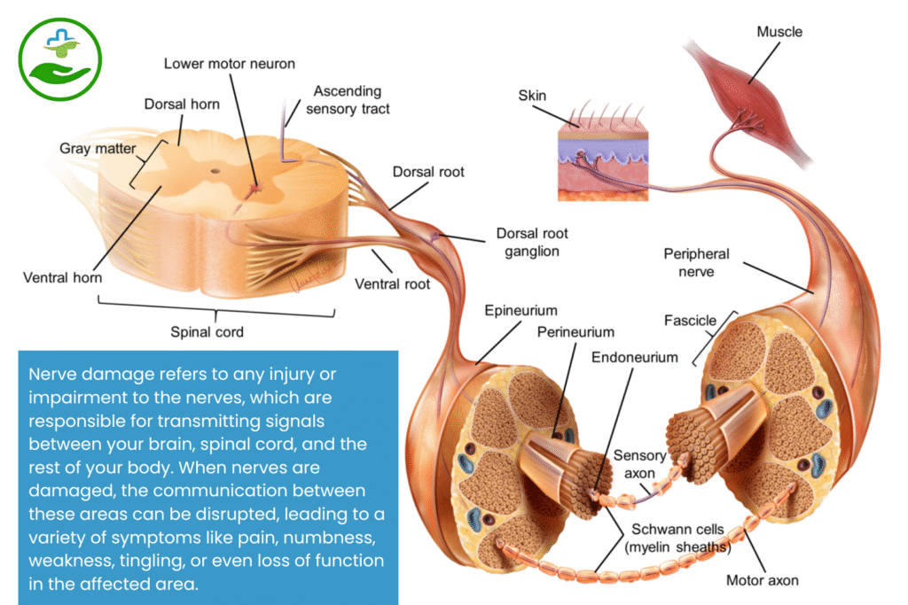 Understanding Nerve Damage