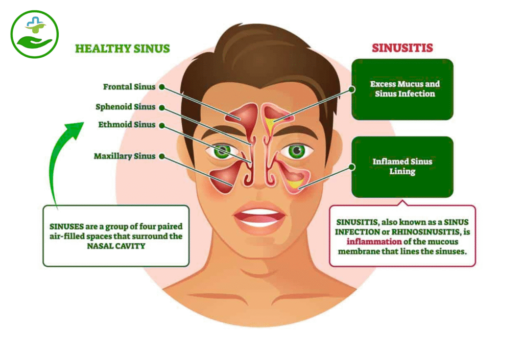 Best Exercise for Sinus Infection Relief – 6 Easy Moves Understanding Sinus Infections and Exercise