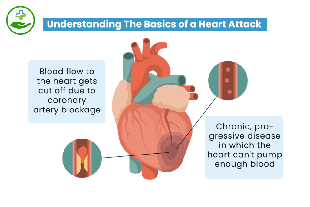 Back Pain Heart Attack? Know the Warning Signs Understanding The Basics of a Heart Attack