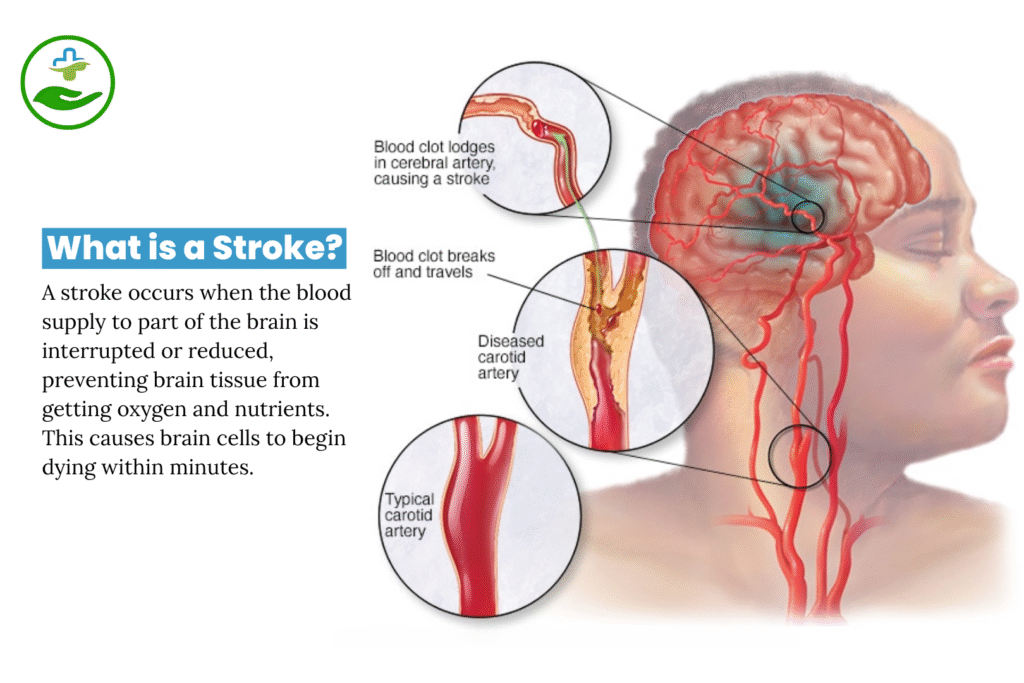 What is a Stroke?