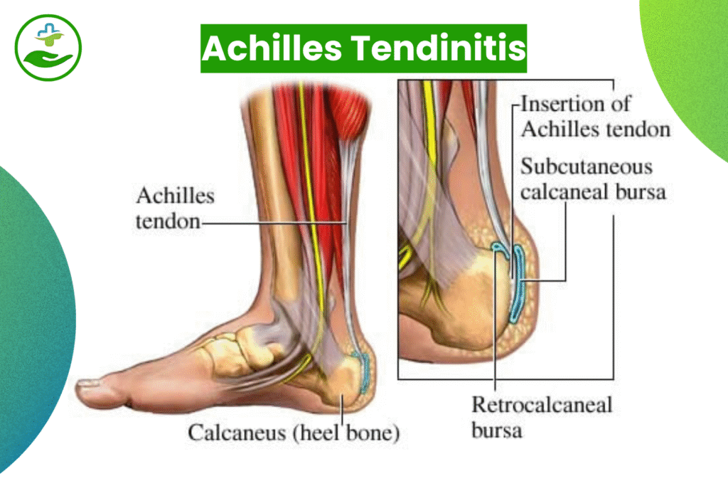 Understanding Foot Pain: An Essential Guide To Foot Pain Chart Achilles Tendinitis