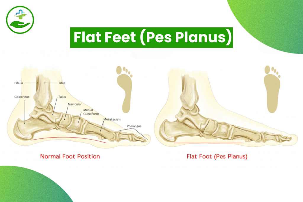 Understanding Foot Pain: An Essential Guide To Foot Pain Chart Flat Feet (Pes Planus)