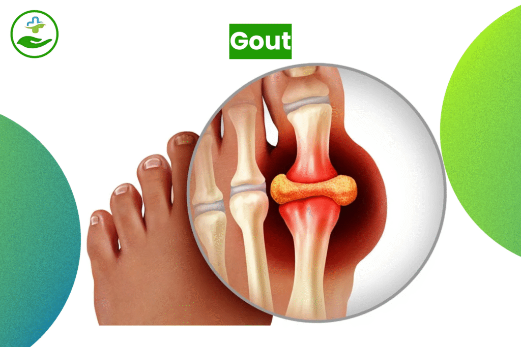 Understanding Foot Pain: An Essential Guide To Foot Pain Chart Gout