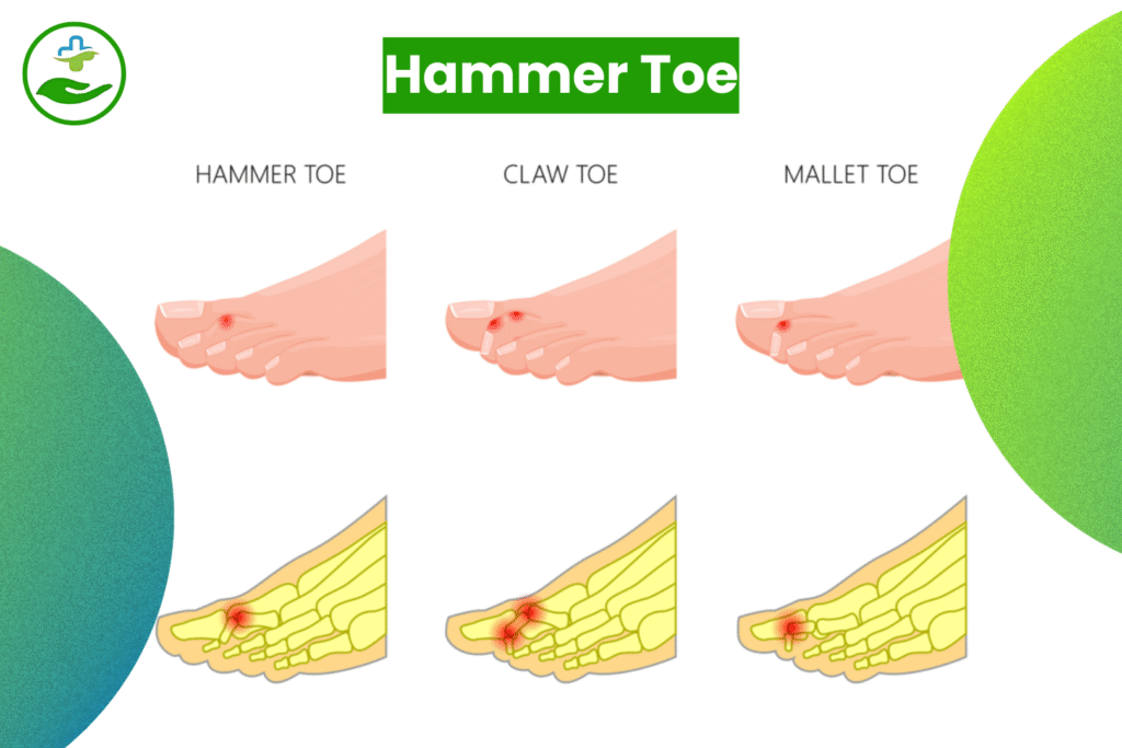 Understanding Foot Pain: An Essential Guide To Foot Pain Chart Hammer Toe