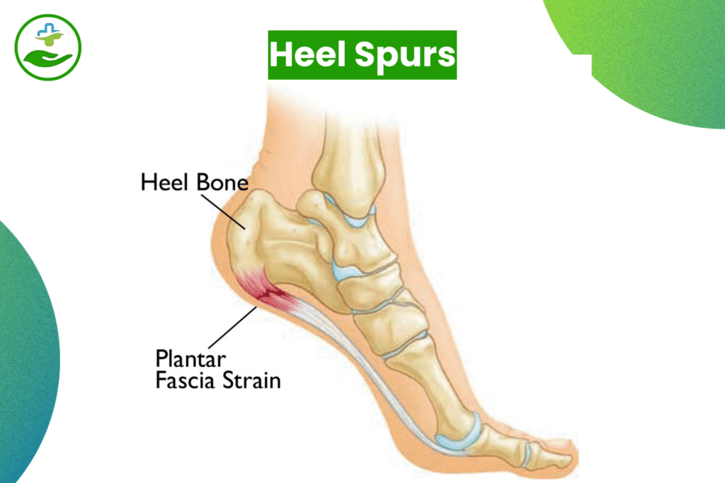 Understanding Foot Pain: An Essential Guide To Foot Pain Chart Heel Spurs
