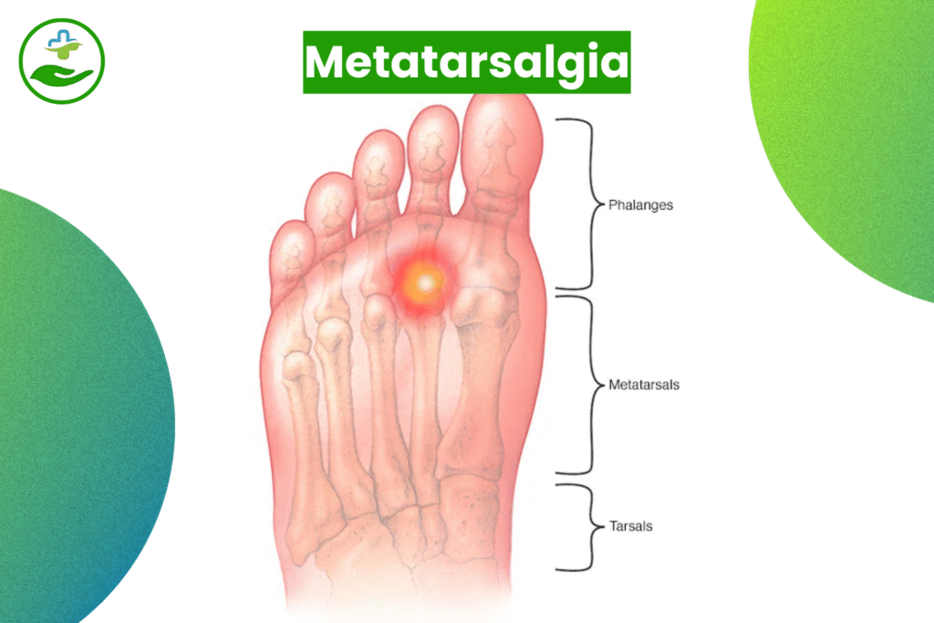 Understanding Foot Pain: An Essential Guide To Foot Pain Chart Metatarsalgia