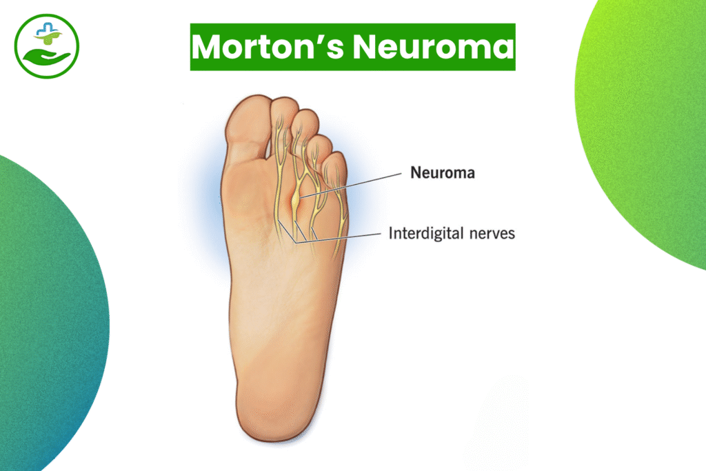Understanding Foot Pain: An Essential Guide To Foot Pain Chart Morton’s Neuroma