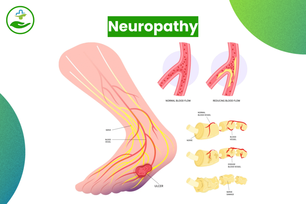Understanding Foot Pain: An Essential Guide To Foot Pain Chart Neuropathy