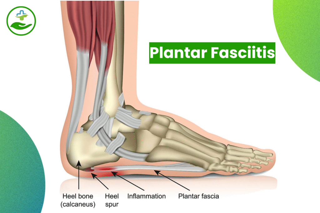 Understanding Foot Pain: An Essential Guide To Foot Pain Chart Plantar Fasciitis