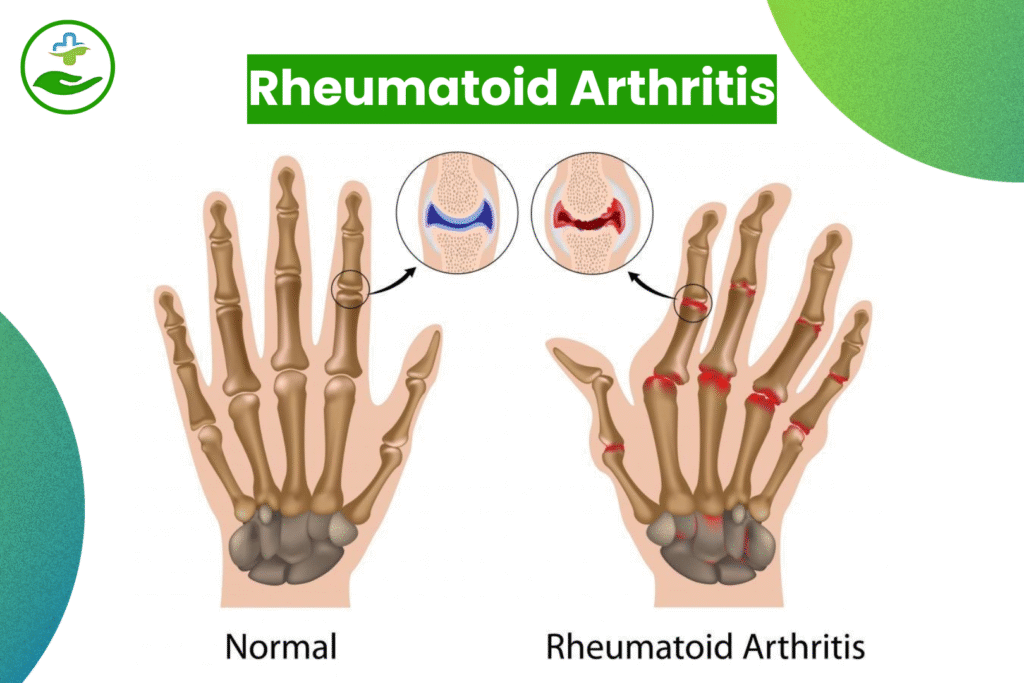 Understanding Foot Pain: An Essential Guide To Foot Pain Chart Rheumatoid Arthritis