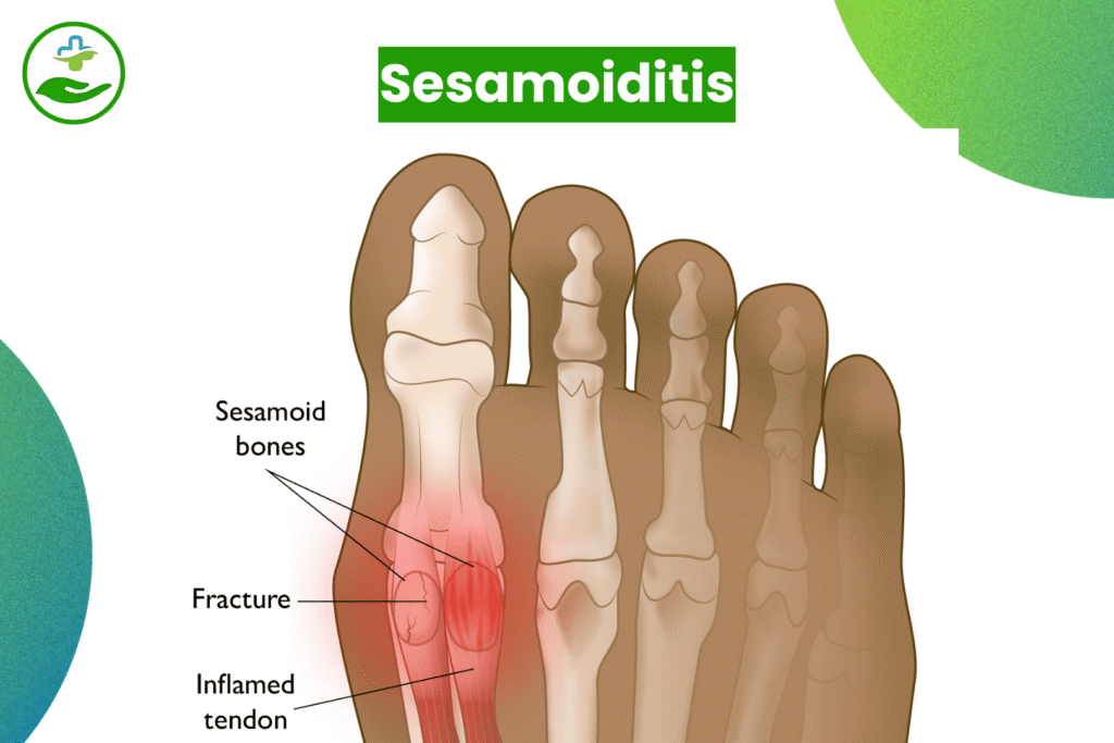 Understanding Foot Pain: An Essential Guide To Foot Pain Chart Sesamoiditis