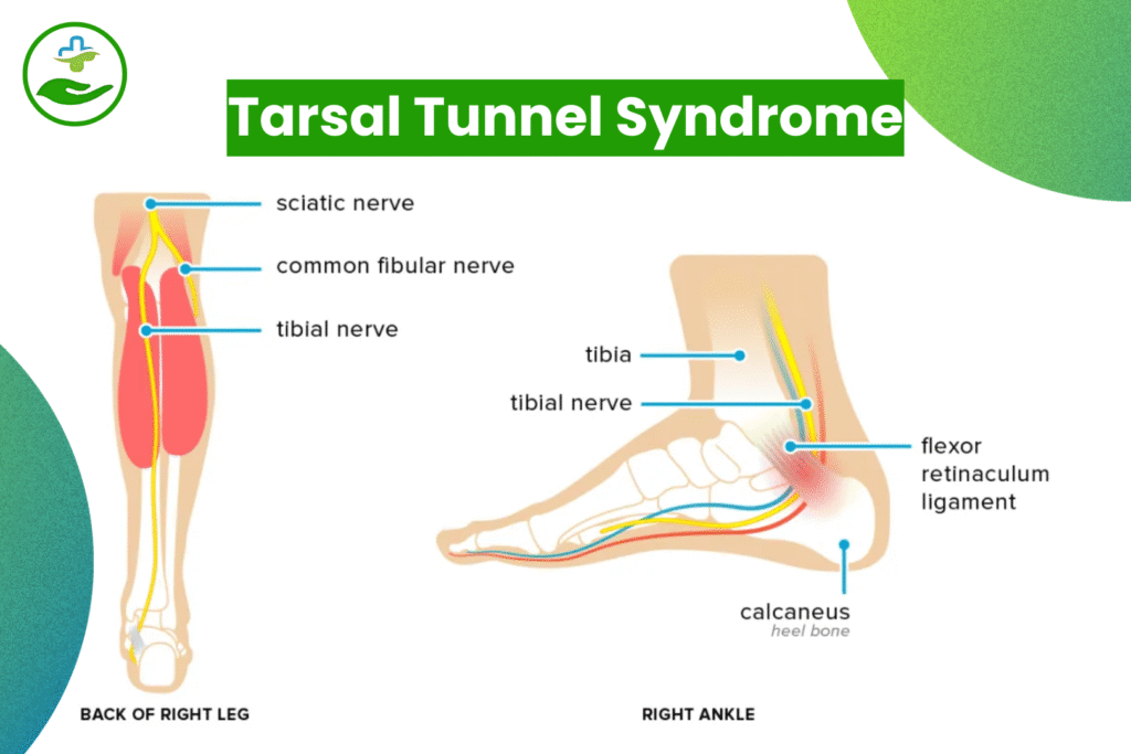 Understanding Foot Pain: An Essential Guide To Foot Pain Chart Tarsal Tunnel Syndrome