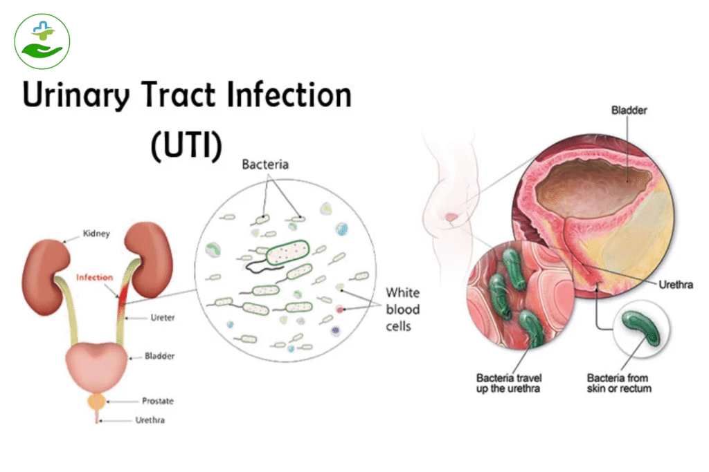 Can Azithromycin Treat UTI