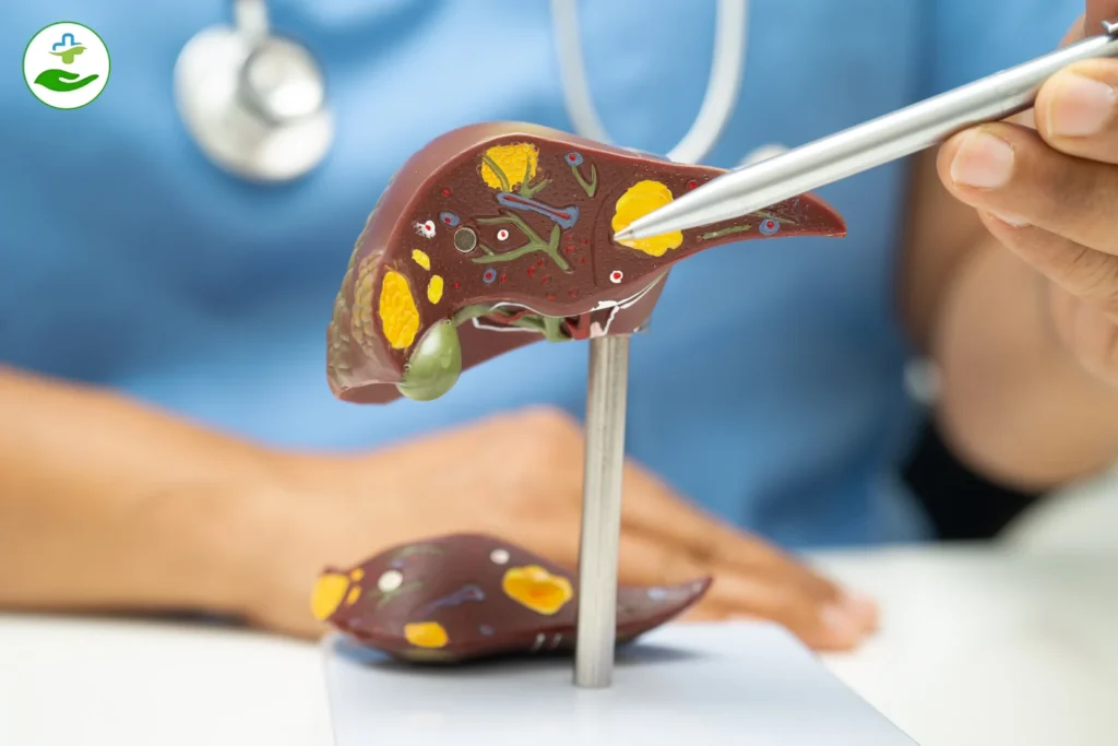 What Foods Cause Gallstones? 10 Risky Picks Gallstones