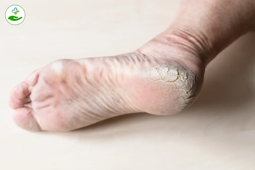 10 Effective Home Remedies For Cracked Heels